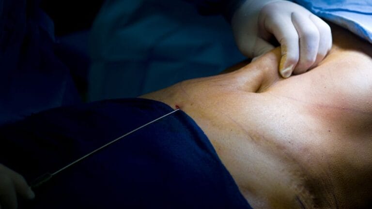 Lipomarcacion abdominal - Dr. Jaime Aroca - Cirujano Plástico en Colombia, Especialista en Abdominoplastia