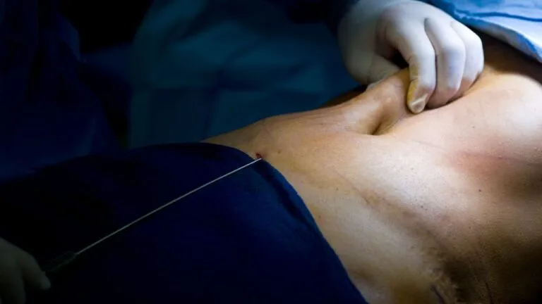 Liposculpture and cellulite - board-certified plastic surgeon explains the difference