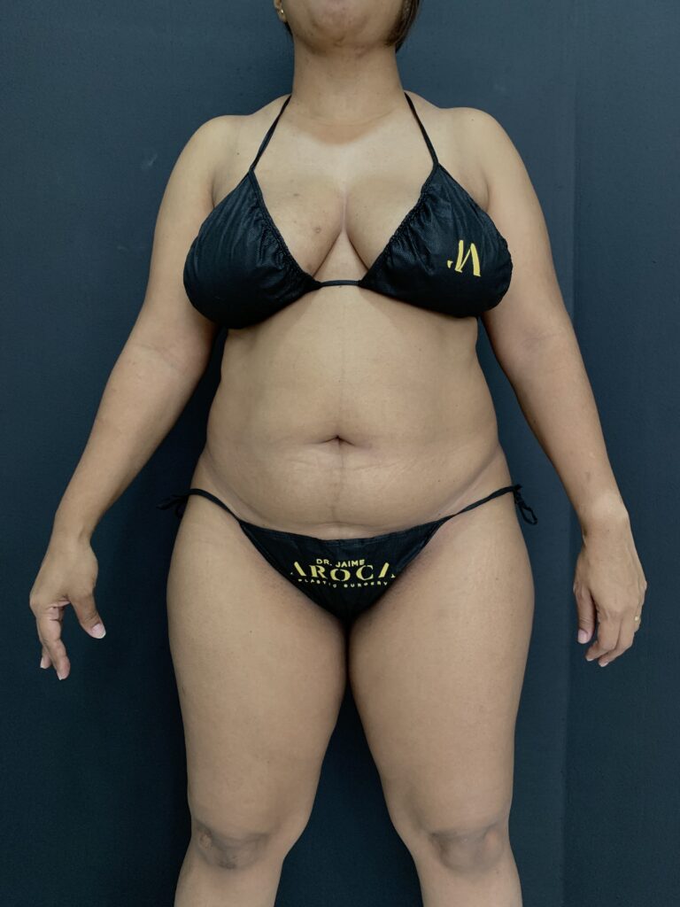 Definición de líneas abdominales mediante lipomarcación de alta precisión.