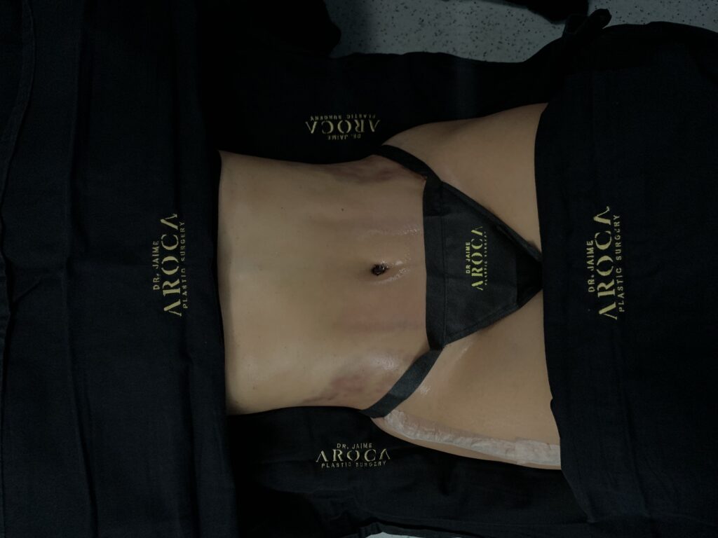 Preparación prequirúrgica para lipoescultura: todo lo que necesitas saber antes de tu cirugía 2 Resultados de abdominoplastia avanzada con técnica de doble corsé en Colombia.