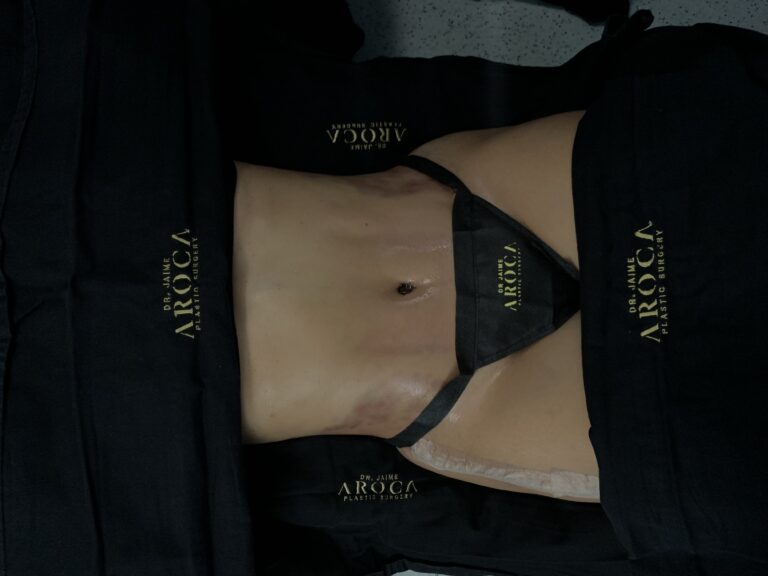 Resultados de abdominoplastia avanzada con técnica de doble corsé en Colombia.