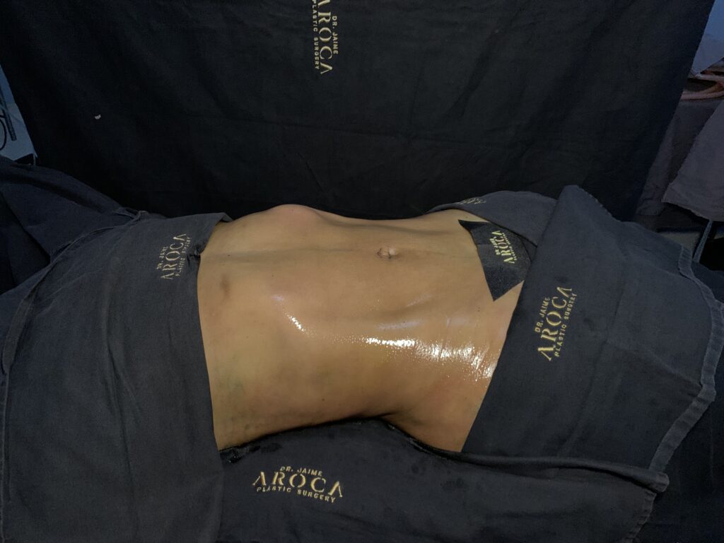 Procedimiento de lipomarcación avanzada para resaltar definición abdominal y contorno corporal.