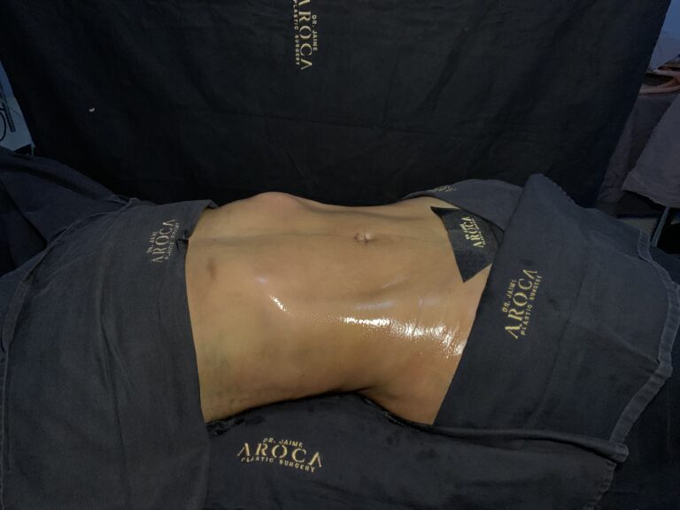 Procedimiento de lipomarcación avanzada para resaltar definición abdominal y contorno corporal.