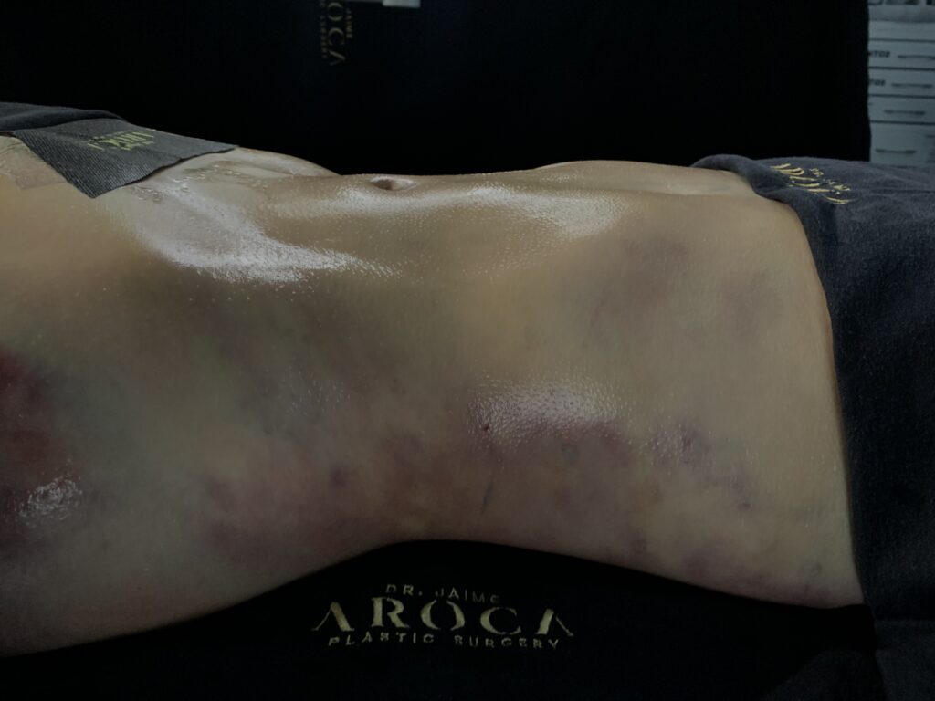 360 liposuction body contouring procedure