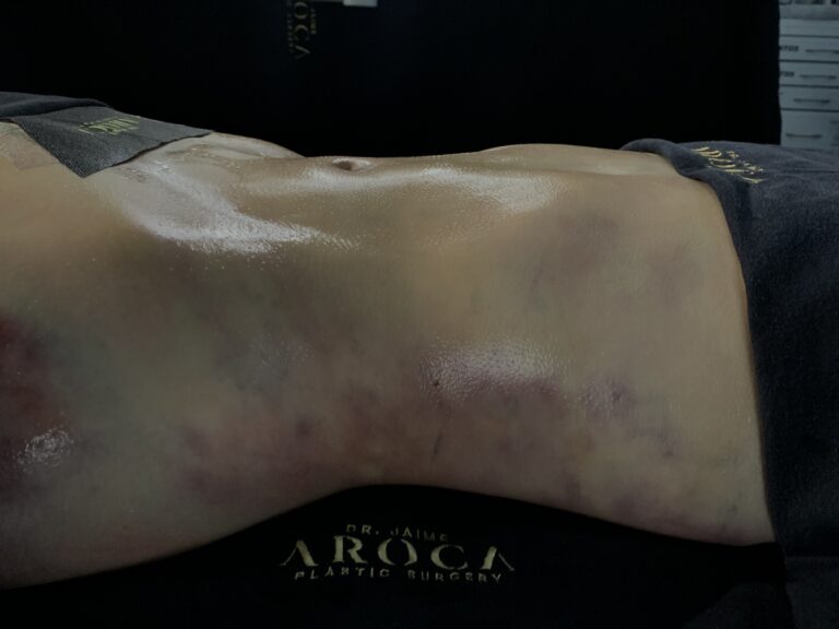 360 liposuction body contouring procedure