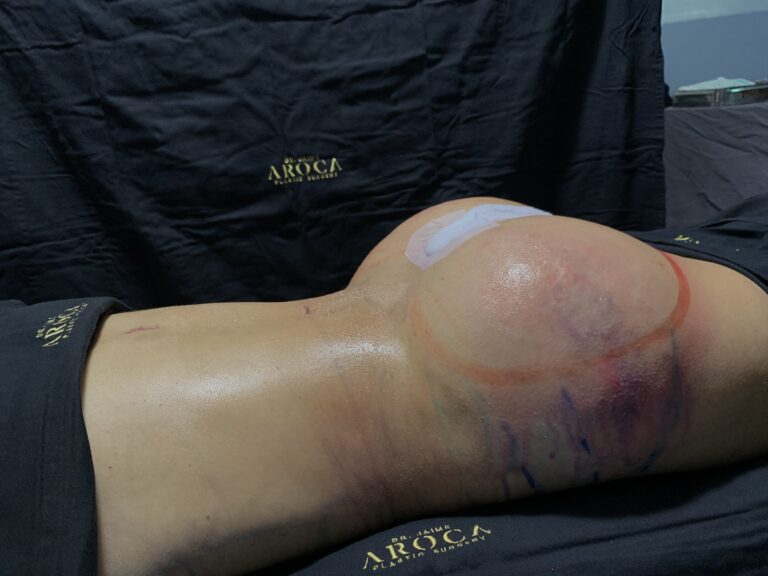 Caso 3 7 1 - Dr. Jaime Aroca - Cirujano Plástico en Colombia, Especialista en Abdominoplastia