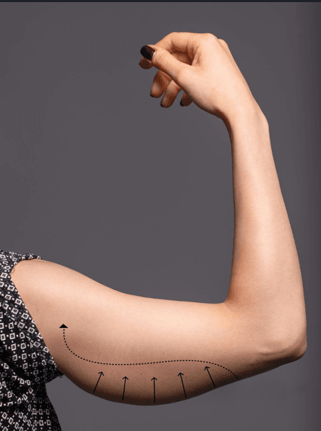 Antes Braquioplastia - Dr. Jaime Aroca - Cirujano Plástico en Colombia, Especialista en Abdominoplastia