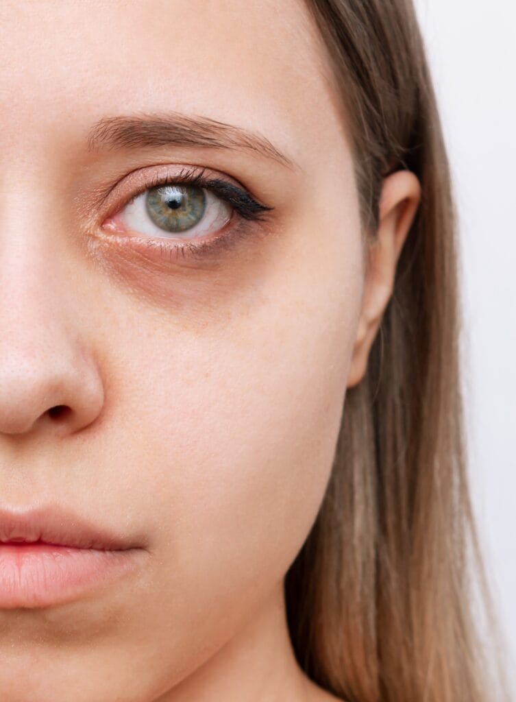 Imagen antes de blefaroplastia mostrando exceso de piel en los párpados superiores