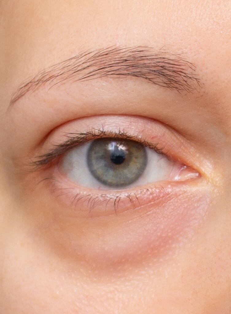 Antes de blefaroplastia con presencia de bolsas en los párpados inferiores