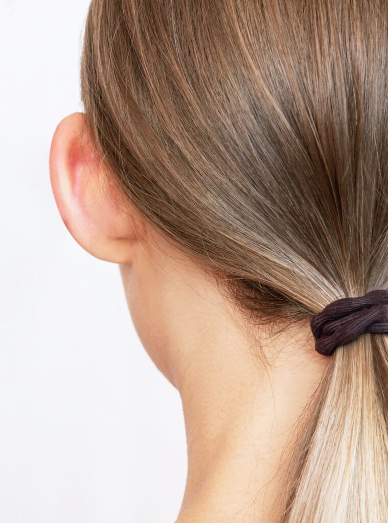 Antes y despues de Otoplastia en adultos - Dr. Jaime Aroca - Cirujano Plástico en Colombia, Especialista en Abdominoplastia