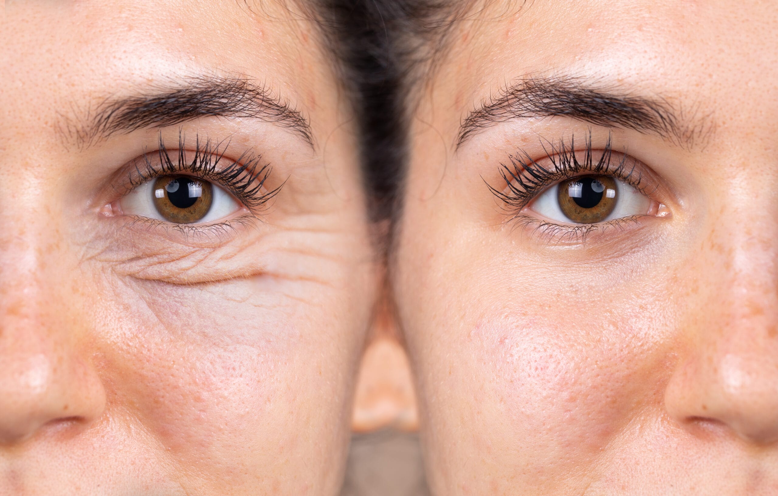 Comparación antes y después de blefaroplastia con mejora visible en la mirada
