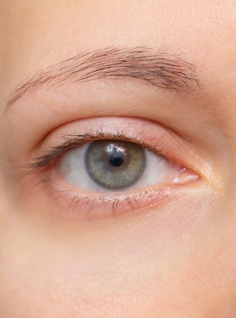Resultado natural de blefaroplastia con reducción de exceso de piel y bolsas