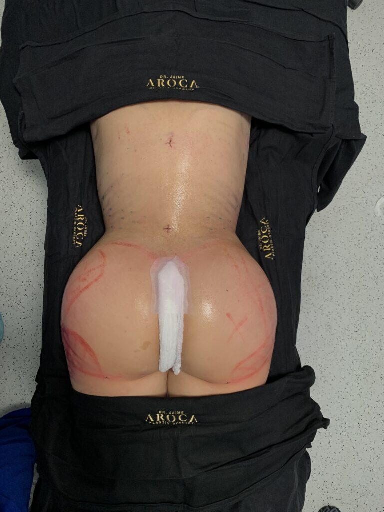 Caso 1 11 - Dr. Jaime Aroca - Cirujano Plástico en Colombia, Especialista en Abdominoplastia