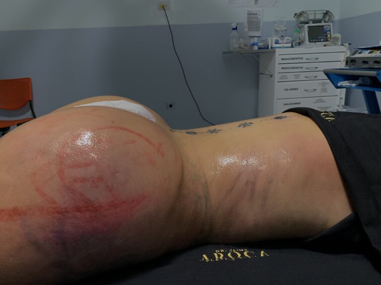 BBL and exercise recovery timeline