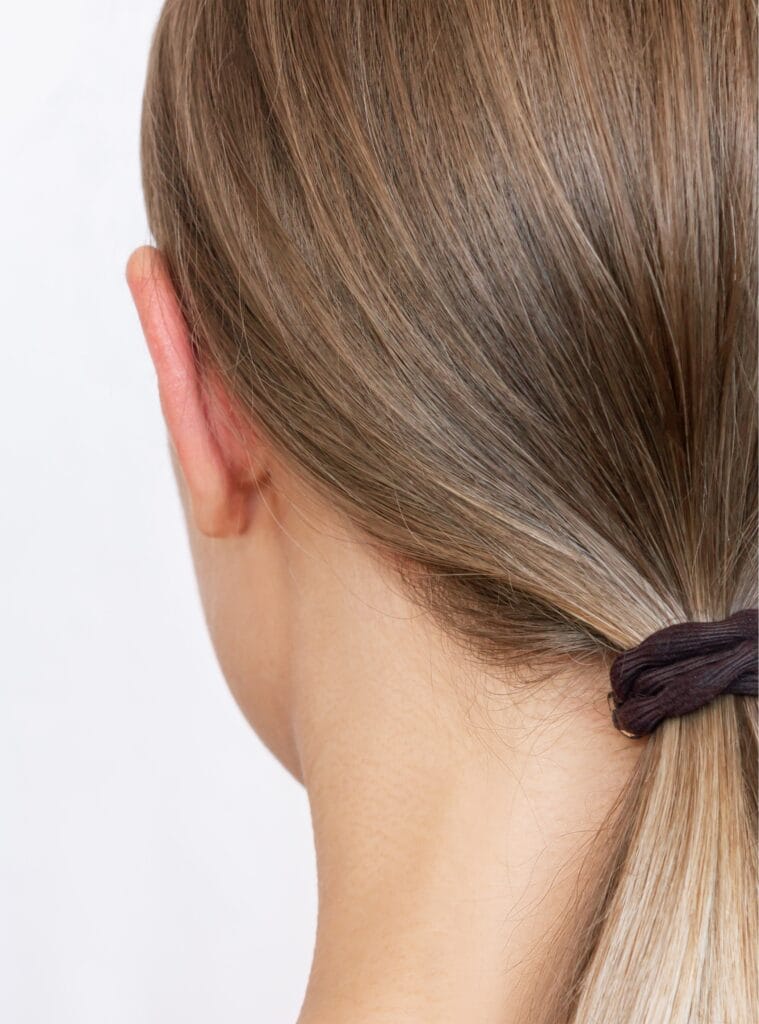 Comparacion lateral antes y despues de otoplastia - Dr. Jaime Aroca - Cirujano Plástico en Colombia, Especialista en Abdominoplastia