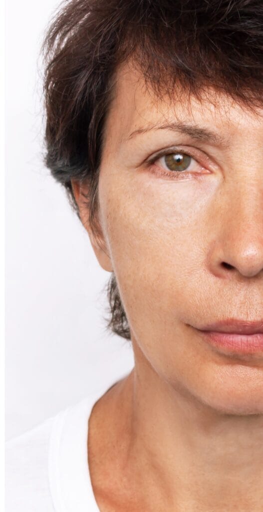 Lifting facial 5 Resultado final de lifting facial con piel más tensa y rejuvenecimiento facial