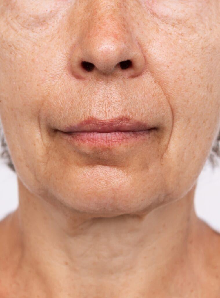 Hyaluronic acid (Profhilo) 4 Imagen facial antes de Profhilo con signos de flacidez leve y disminución de la calidad de la piel