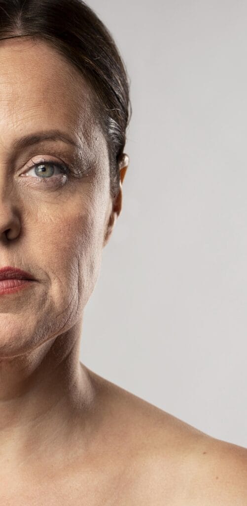 Mujer con líneas de expresión en frente y entrecejo antes de tratamiento de Facial Botulinum antiarrugas