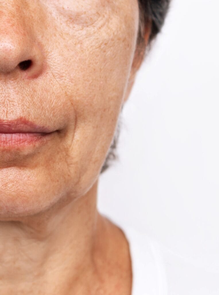 Lifting facial 3 Fotografía del rostro antes de lifting facial con signos de envejecimiento facial