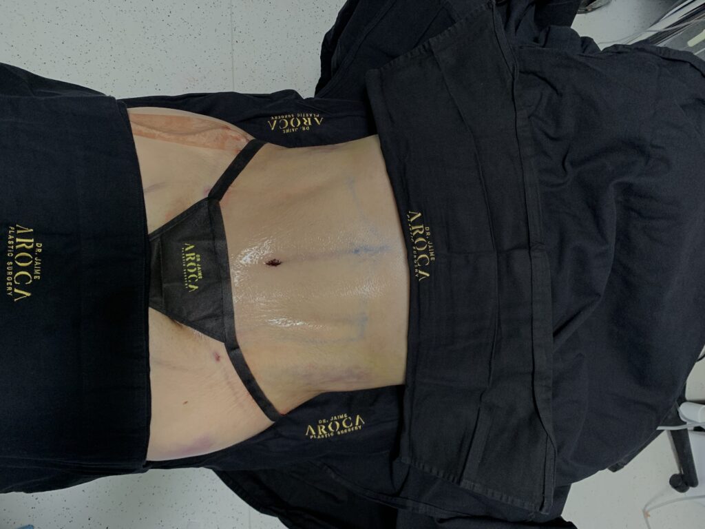 Abdominoplastia y dolor: qué es normal y cuándo consultar 5 abdominoplastia con el mejor cirujano plastico dr jaime aroca - Dr. Jaime Aroca - Cirujano Plástico en Colombia, Especialista en Abdominoplastia