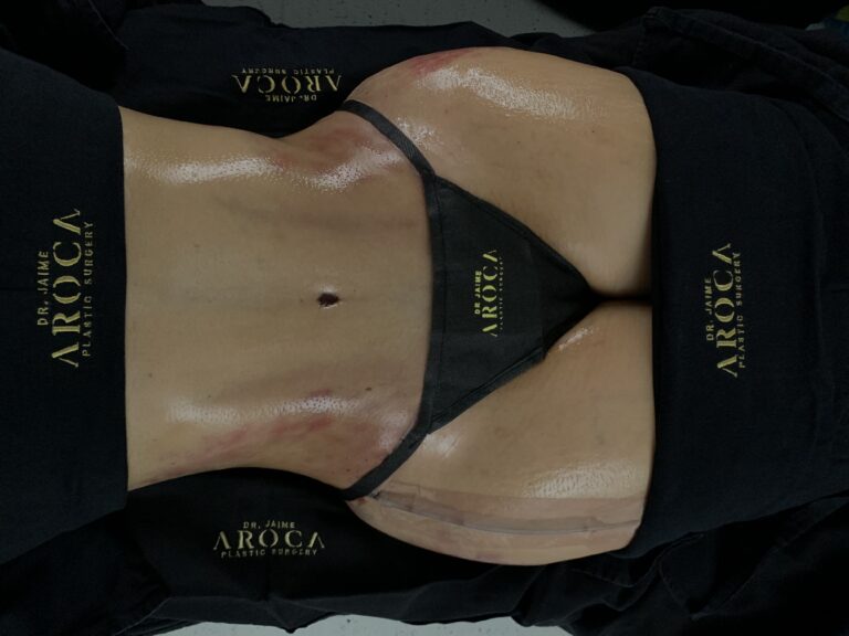 abdominoplastia dr aroca colombia - Dr. Jaime Aroca - Cirujano Plástico en Colombia, Especialista en Abdominoplastia