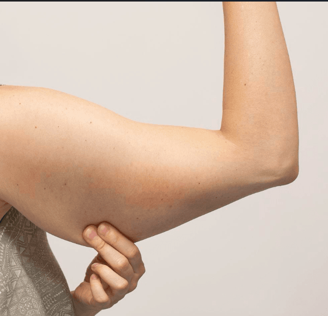 antes braquioplastia 02 - Dr. Jaime Aroca - Cirujano Plástico en Colombia, Especialista en Abdominoplastia