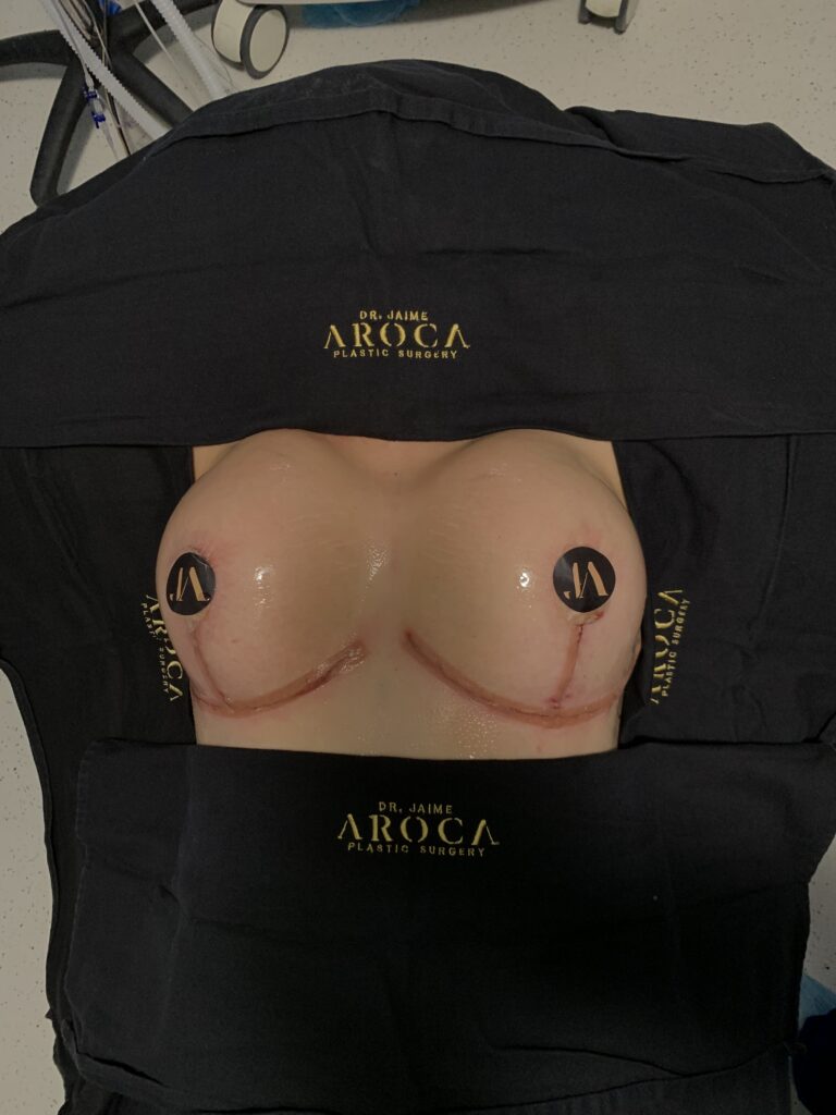 Mastopexia 3 Mamoplastia de Aumento