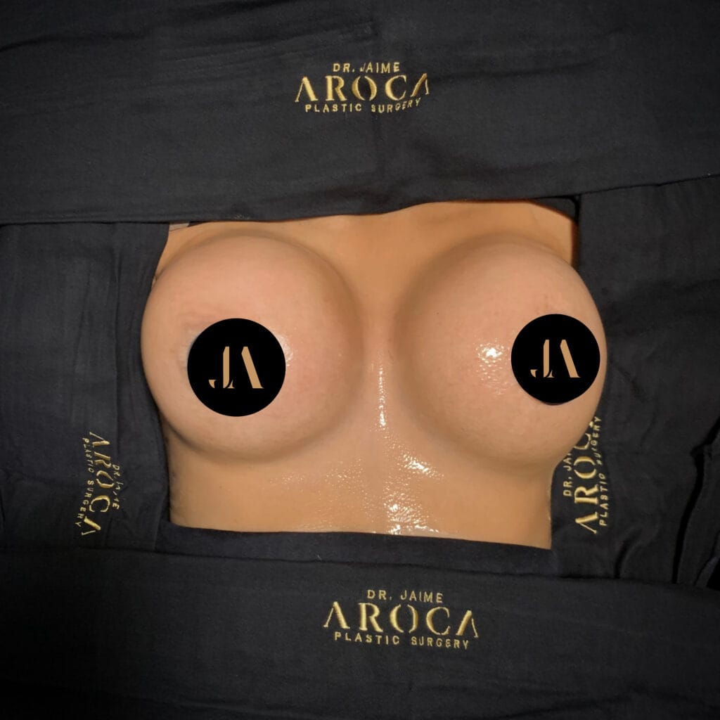 caso 2 11 - Dr. Jaime Aroca - Cirujano Plástico en Colombia, Especialista en Abdominoplastia