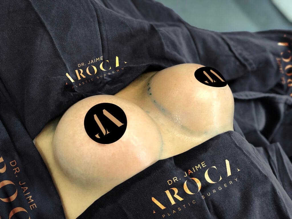 caso 6 - Dr. Jaime Aroca - Cirujano Plástico en Colombia, Especialista en Abdominoplastia