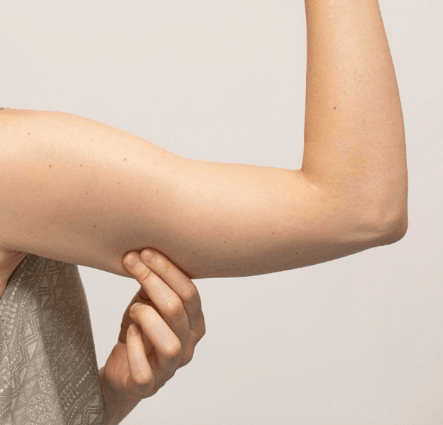 despues braquioplastia 02 - Dr. Jaime Aroca - Cirujano Plástico en Colombia, Especialista en Abdominoplastia