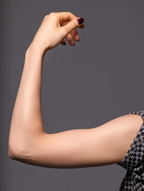 Arm liposuction procedure for localized fat removal