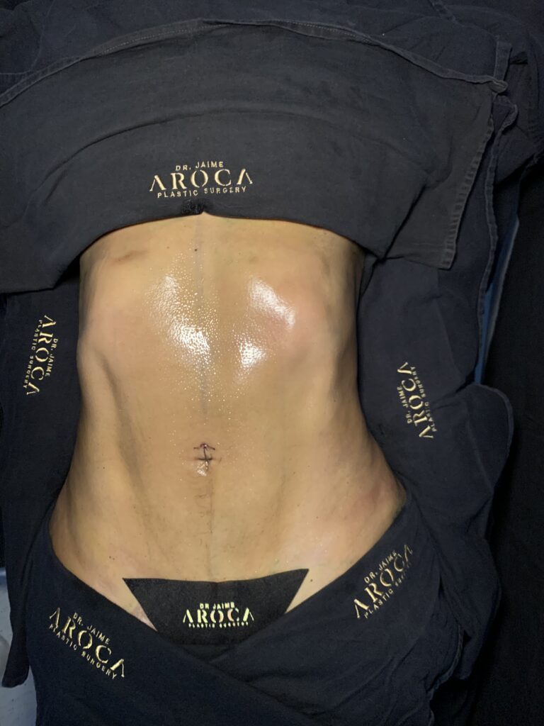 Caso 1 1 - Dr. Jaime Aroca - Cirujano Plástico en Colombia, Especialista en Abdominoplastia
