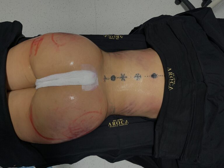 Warning signs after a BBL surgery