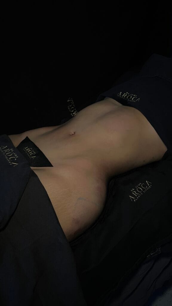 caso 4 1 - Dr. Jaime Aroca - Cirujano Plástico en Colombia, Especialista en Abdominoplastia